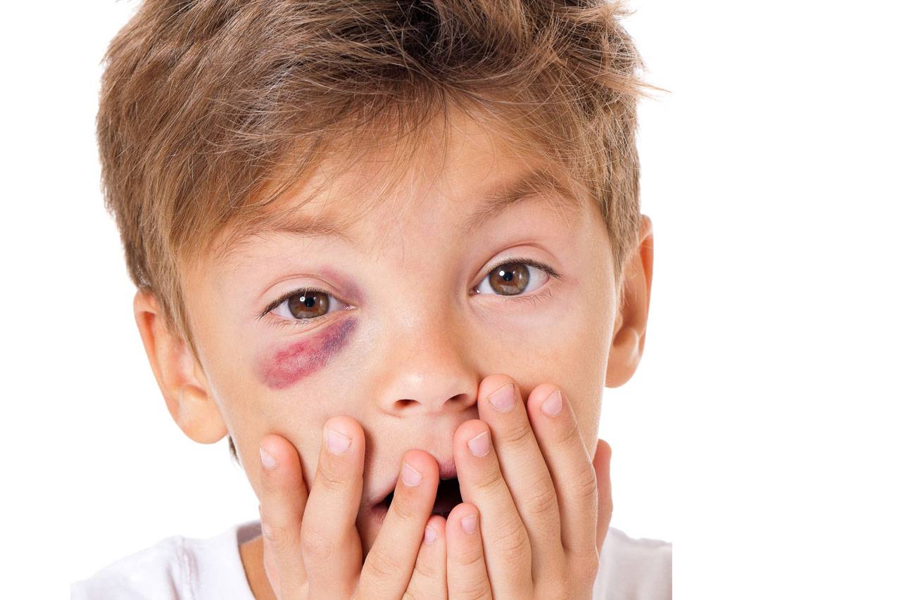 got-a-shiner-what-exactly-is-a-black-eye-eye-medical-clinic